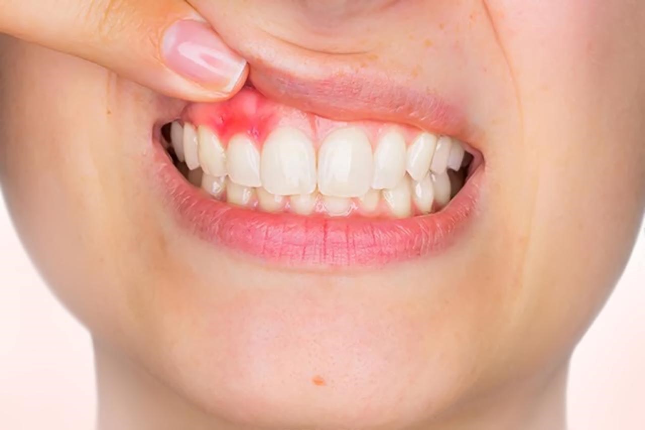 Viêm nướu là nguyên nhân hàng đầu gây chảy máu chân răng