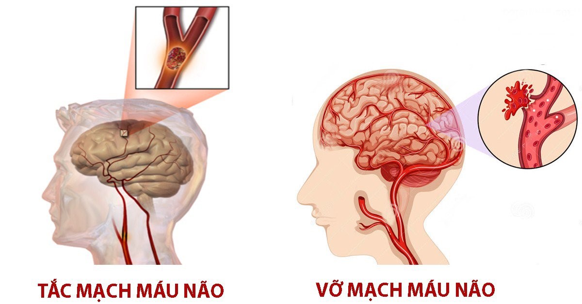 tắc,vỡ mạch máu
