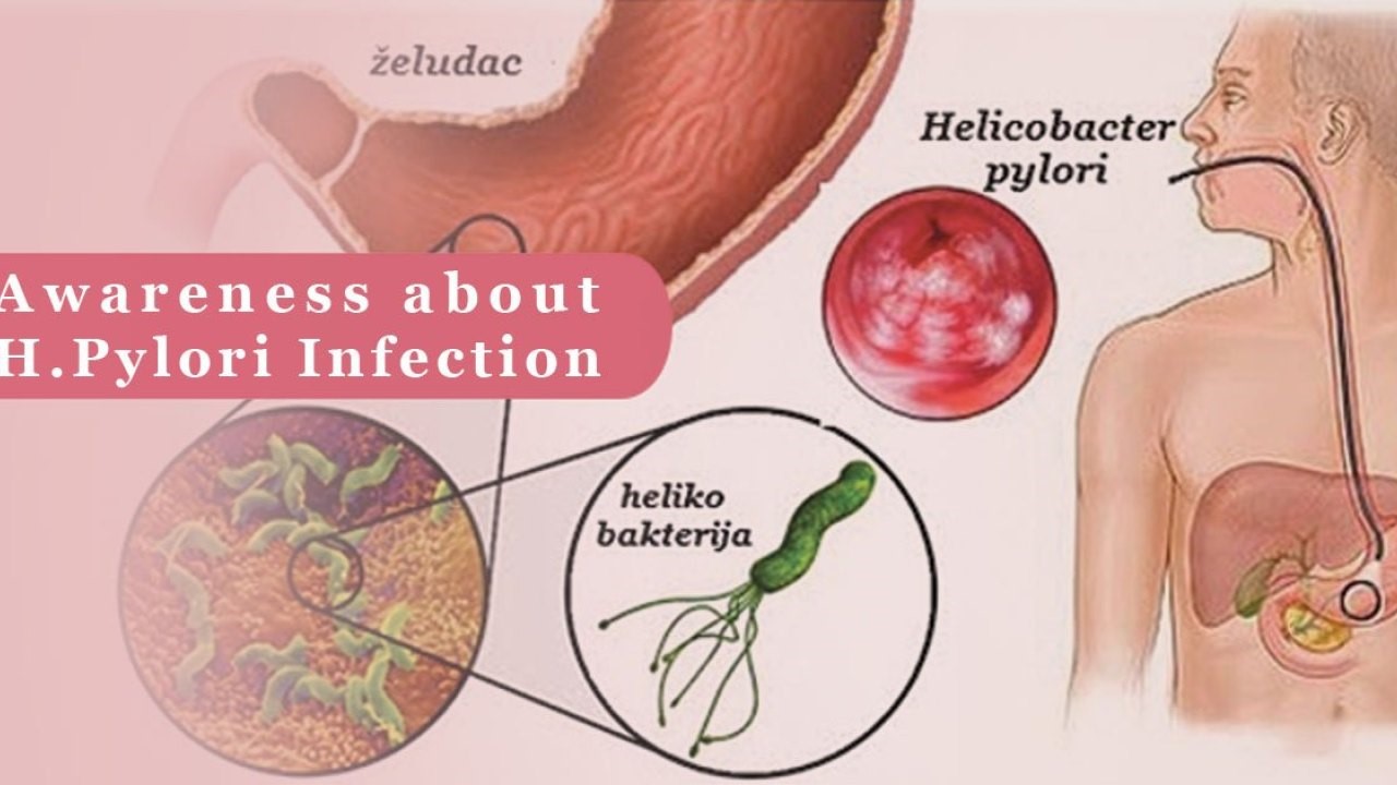 Nhiễm vi khuẩn Helicobacter pylori (HP) là nguyên nhân hay gặp nhất của viêm loét dạ dày