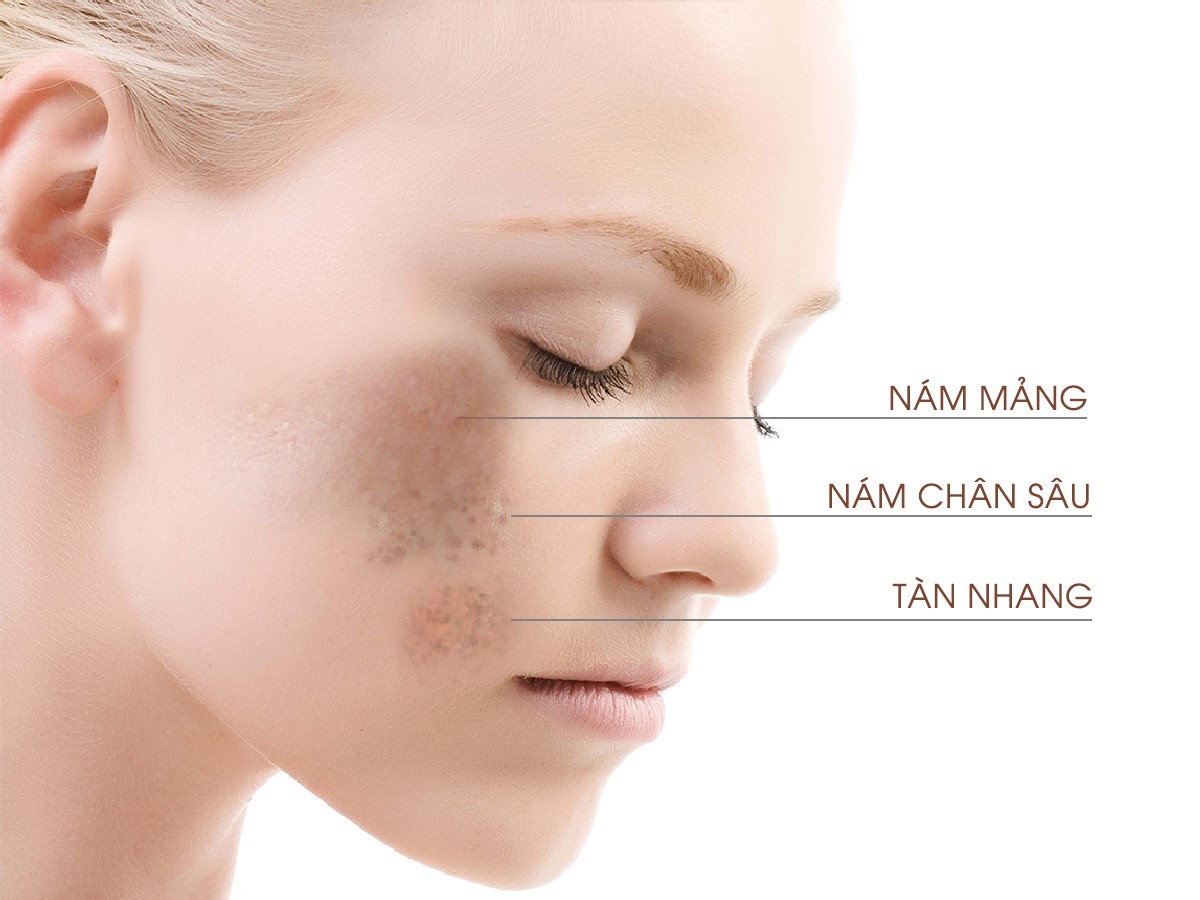 nhiều chị em sau một thời gian đi nắng thì trên da xuất hiện nám, sạm, tàn nhang