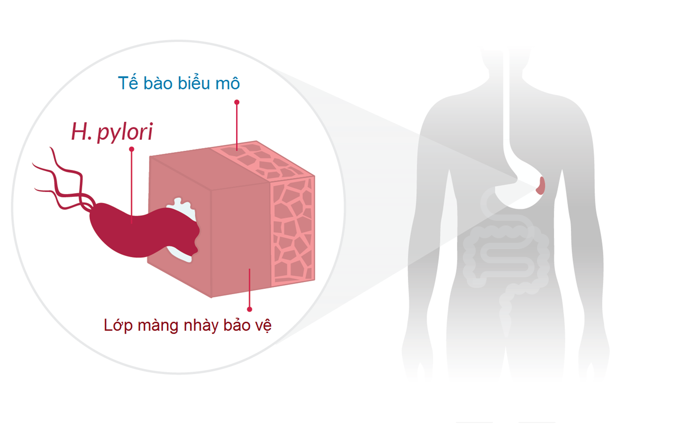 Viêm loét dạ dày tá tràng do H. pylori