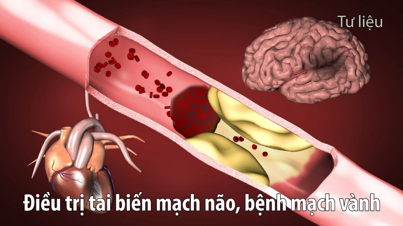 bị đau thắt ngực