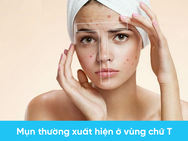 Da hỗn hợp là loại da khó chăm sóc nhất