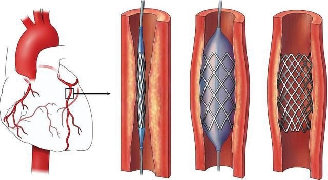Stent mạch vành