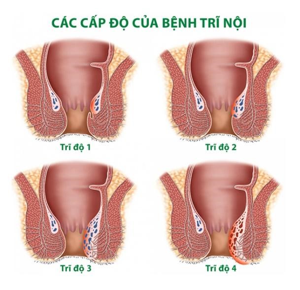 4 cấp độ bệnh trĩ nội