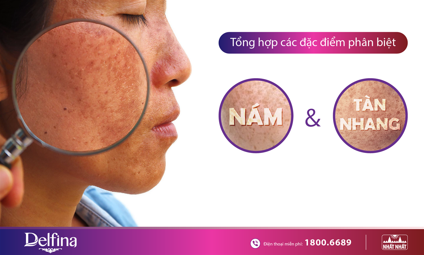 nám da và tàn nhang