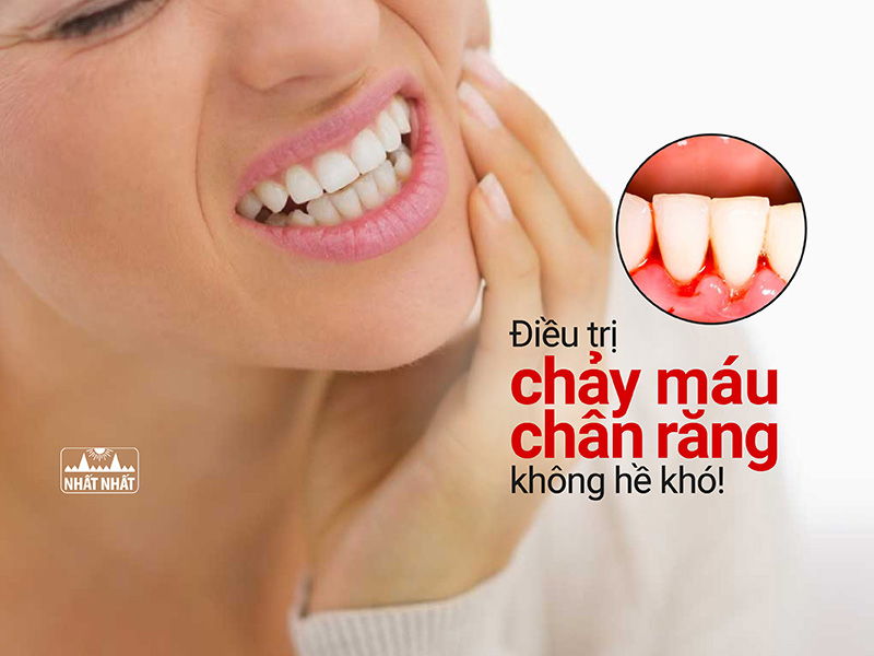 chảy máu chân răng kéo dài