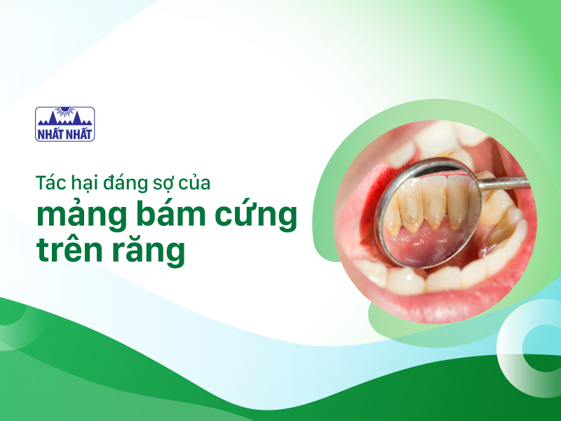 mảng bám cứng trên răng