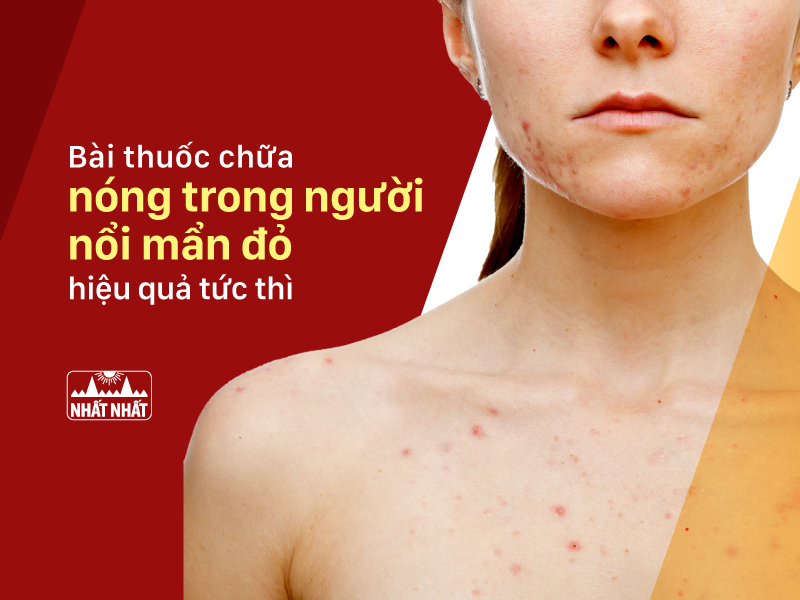 nóng trong người nổi mẩn đỏ