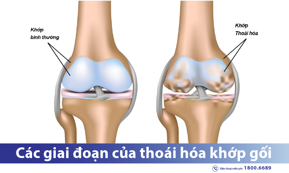thoái hóa khớp gối