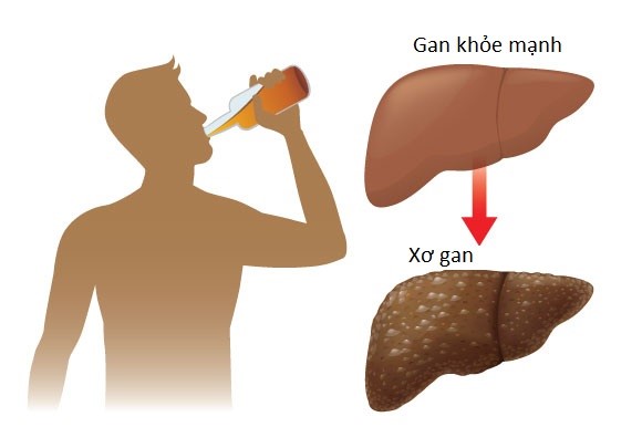  giải độc gan sau khi uống bia rượu