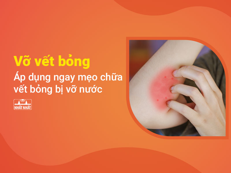 chữa vết bỏng bị vỡ nước