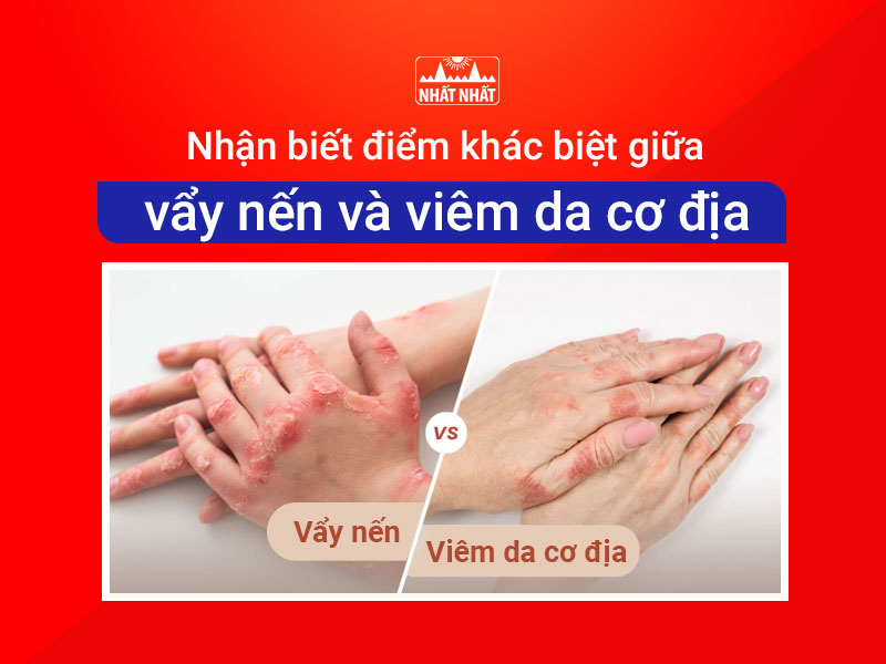 Vẩy nến và viêm da cơ địa 
