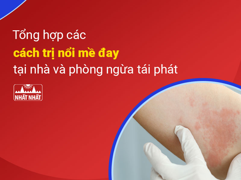 cách trị nổi mề đay tại nhà