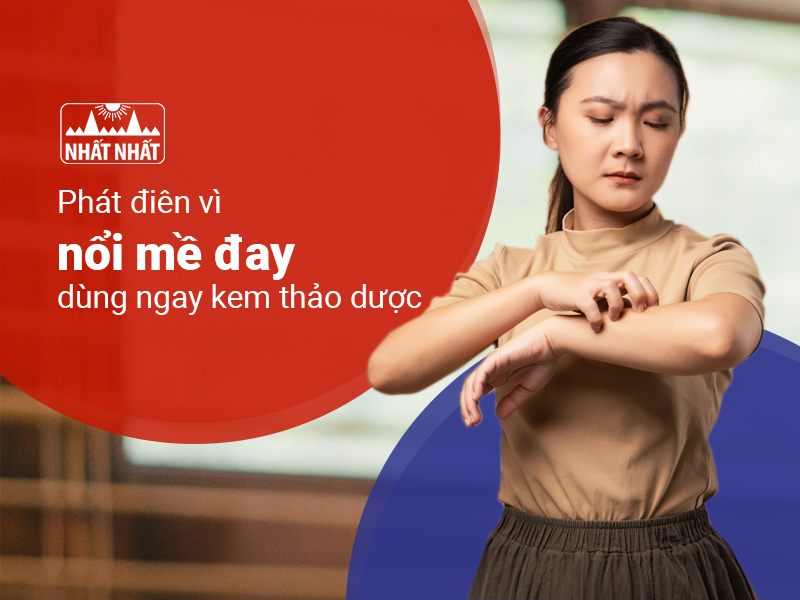 nổi mề đay