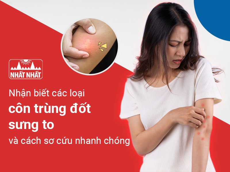 côn trùng đốt sưng to