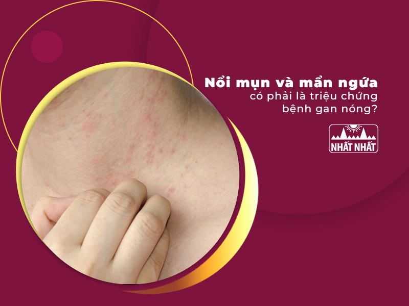 triệu chứng bệnh gan nóng