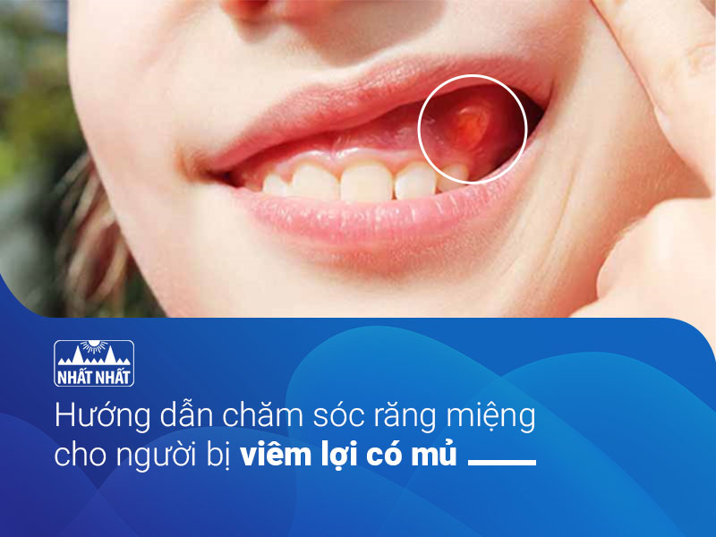 Viêm lợi có mủ 