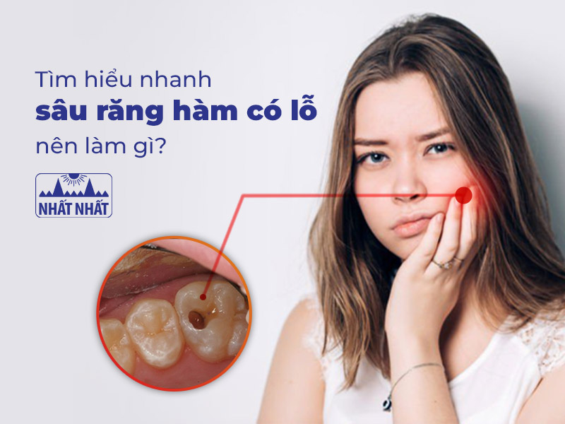 sâu răng hàm có lỗ