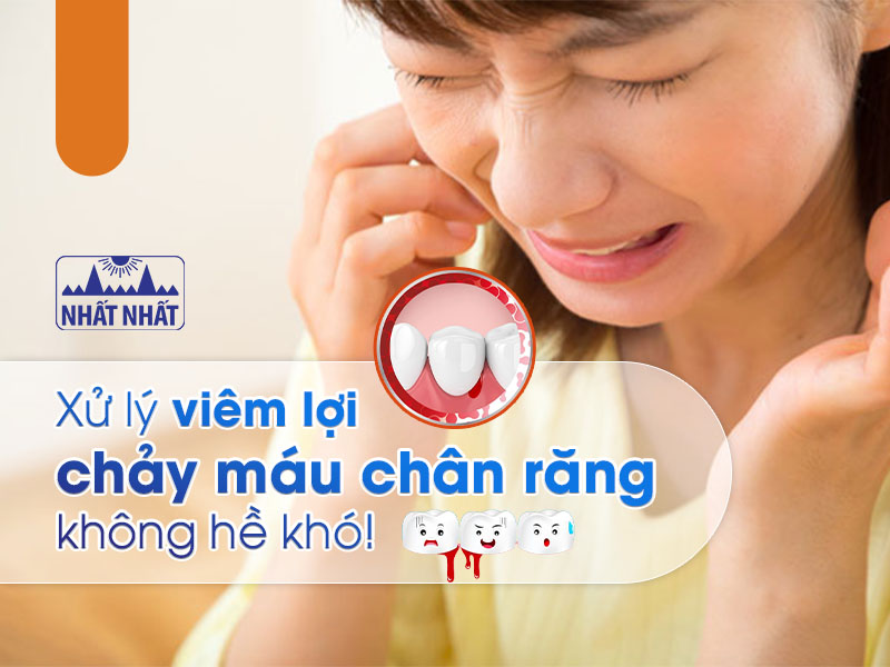 viêm lợi chảy máu chân răng