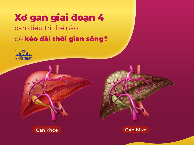 xơ gan giai đoạn 4