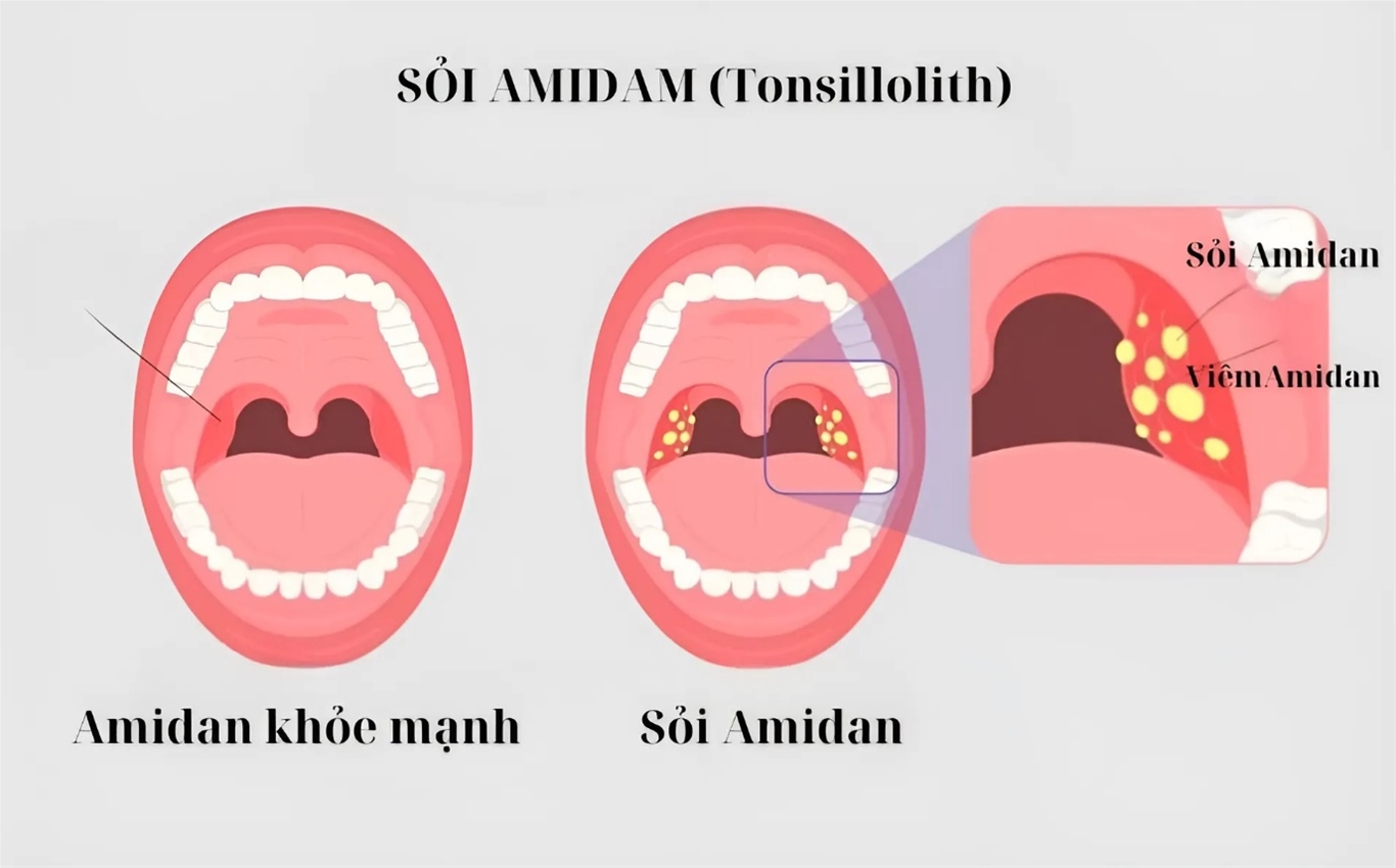 Amidan bình thường và Sỏi amidan