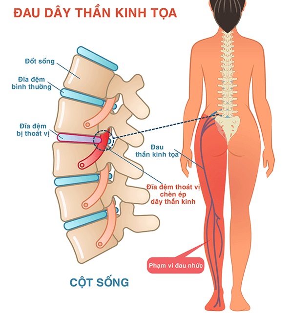 bệnh đau thần kinh tọa