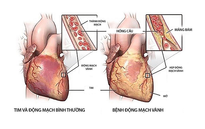 Bệnh động mạch vành nguyên dân do sự thu hẹp động mạch