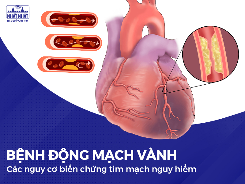 Bệnh động mạch vành và các biến chứng tim mạch của bệnh