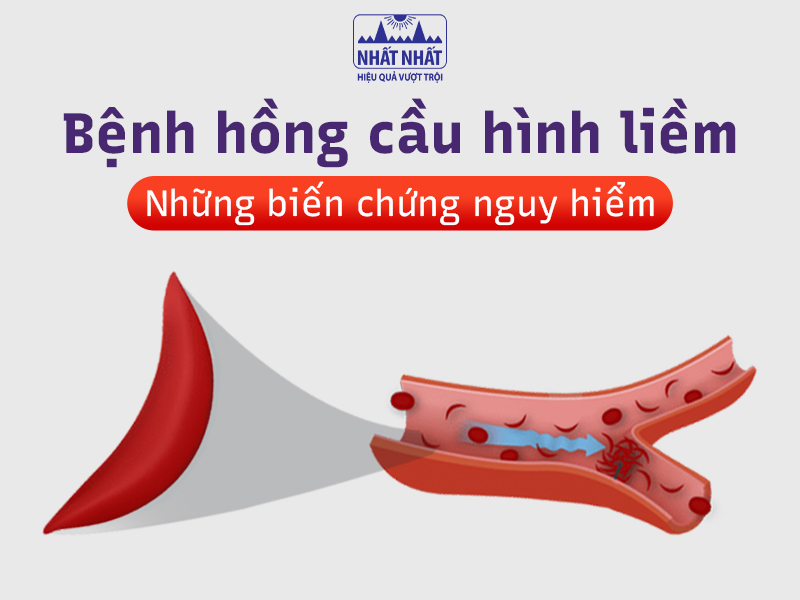 Bệnh hồng cầu gây nhiều ảnh hưởng cho sức khỏe