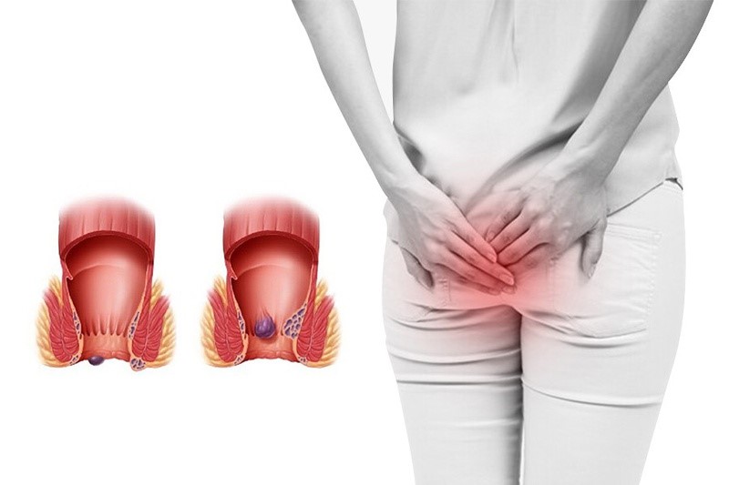 Bệnh trĩ sau sinh khá phổ biến