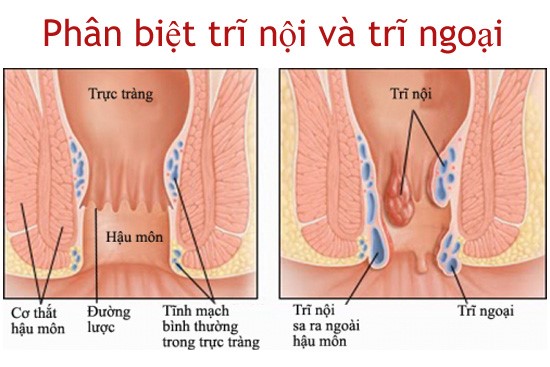 bệnh trĩ uống thuốc gì
