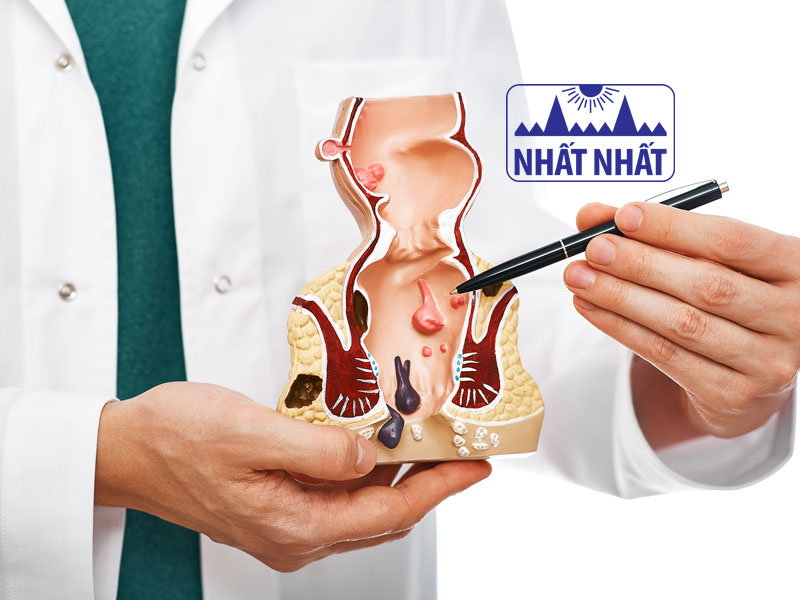 bệnh trĩ và cách điều trị tại nhà