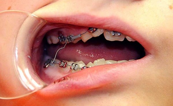 bệnh loét miệng