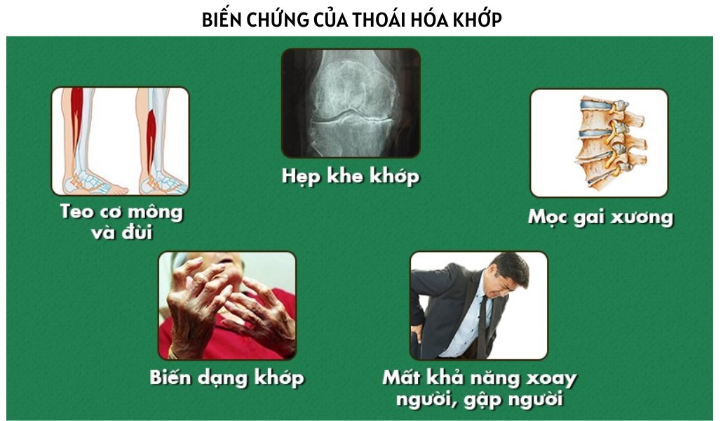 Biến chứng nguy hiểm của thoái hóa khớp