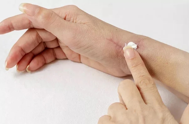 Bôi kem giúp mau liền da vùng tổn thương