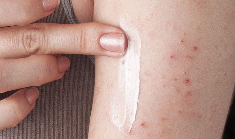 Bôi kem thảo dược giúp sát trùng, tiêu viêm, giảm ngứa da