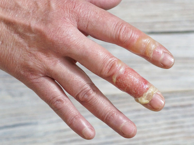 chữa vết bỏng bị vỡ nước