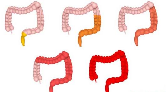 Các mức độ lan rộng của viêm loét đại trực tràng