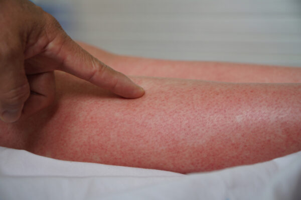Các nốt phát ban sẽ nổi lên sau 3-4 ngày bị sốt