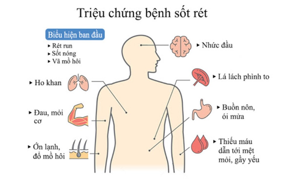 Các triệu chứng bệnh sốt rét