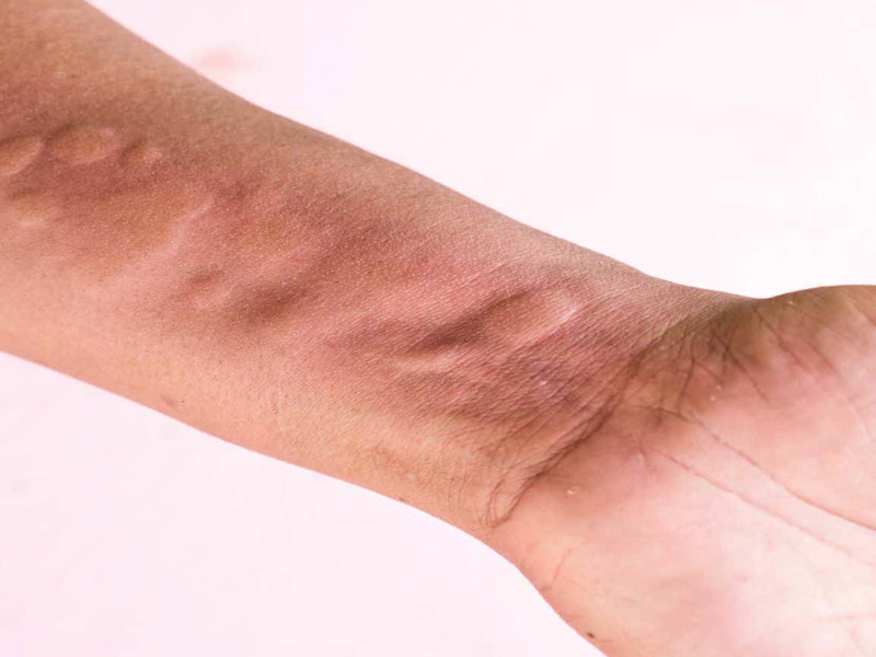 cách trị nổi mề đay tại nhà