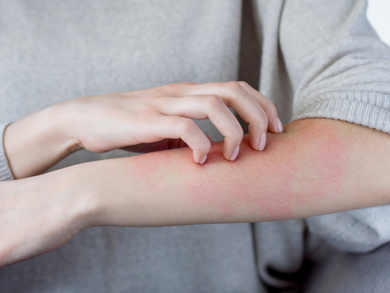 cách trị nổi mề đay tại nhà