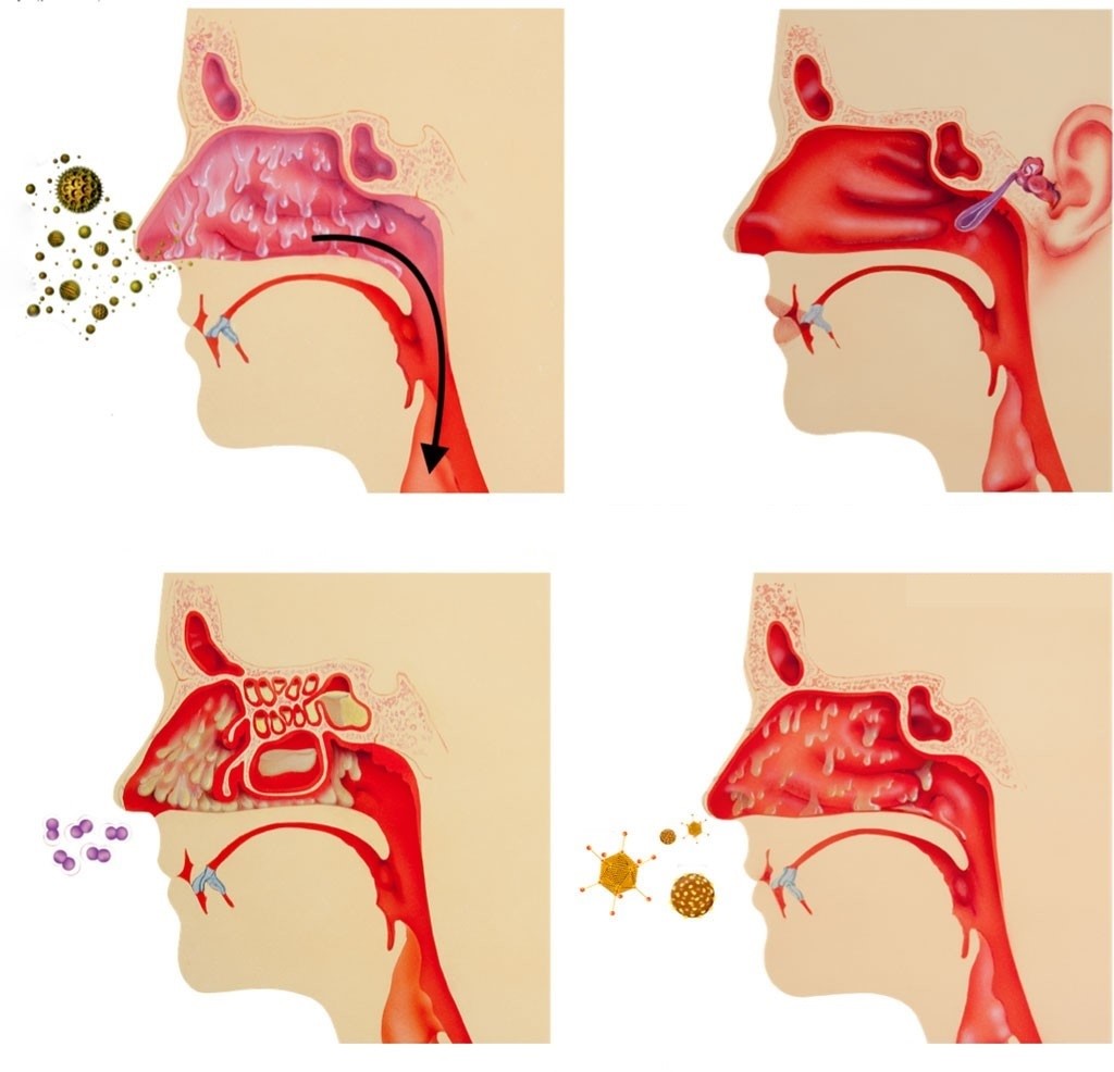 cách xịt nước muối biển cho bé