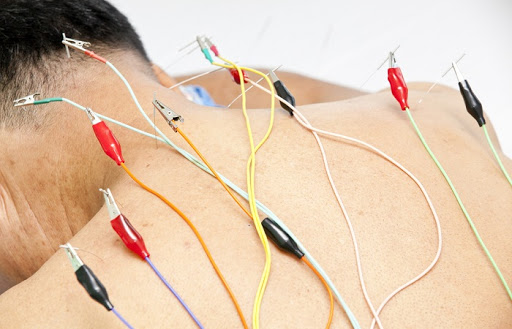 Châm cứu trong y học cổ truyền