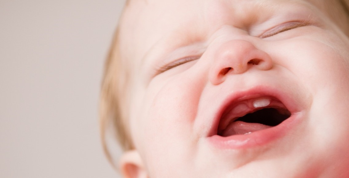 Viêm nướu răng trẻ em