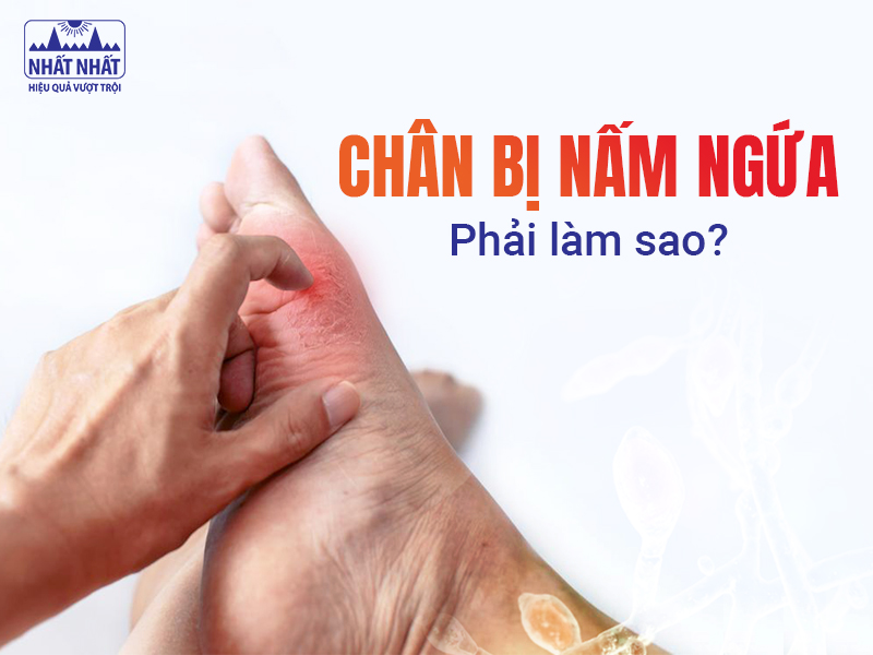 Chân bị nấm ngứa gây khó chịu cho nhiều người