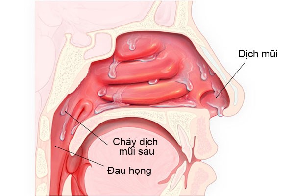 Chảy dịch mũi sau do viêm xoang gây ho kéo dài