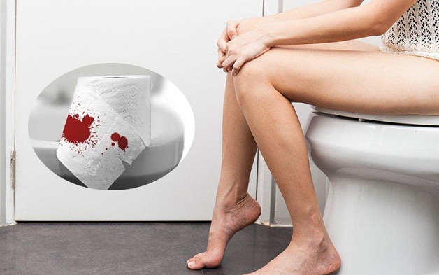 Chảy máu là triệu chứng đặc trưng của trĩ