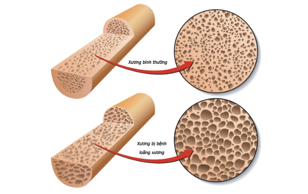 Loãng xương là một nguyên nhân gây tình trạng tê mỏi chân tay